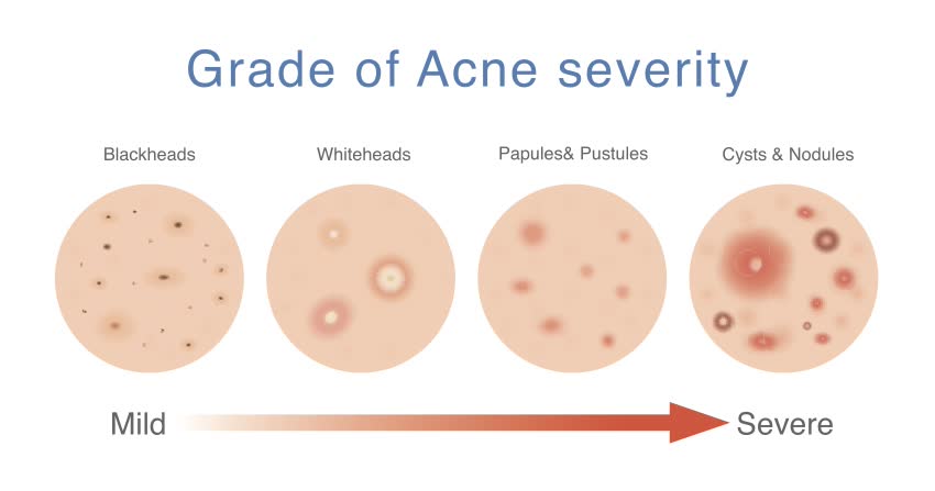 Stadi dell'acne - acne cistica