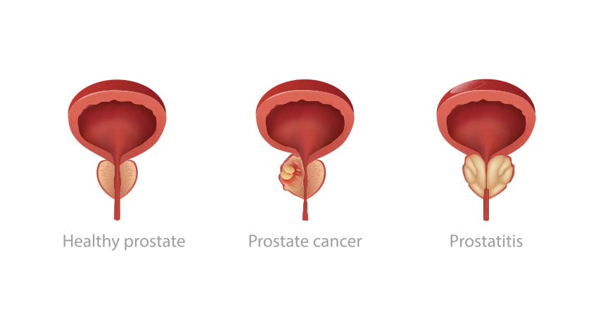 Rappresentazione grafica prostata sana, cancro alla prostata e prostatite