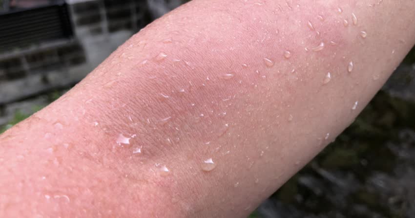 Close up braccio che prude dopo la doccia