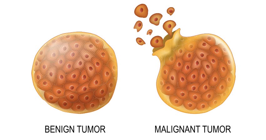 Raffigurazione cellule tumore benigno e tumore maligno