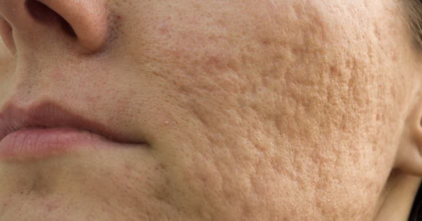 Close up del viso di una persona con evidenti cicatrici da acne
