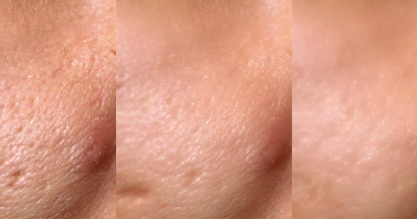 Close up pelle di viso in fasi successive di trattamento per rimuovere le cicatrici da acne