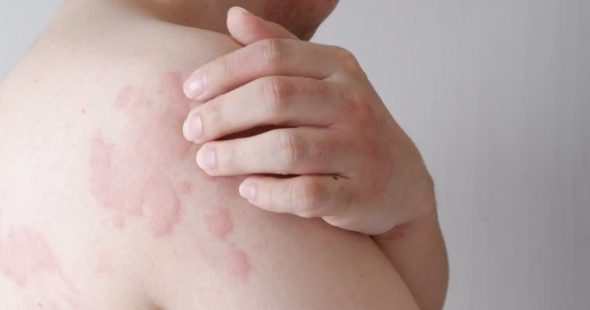 Close up di pomfi sulla pelle da allergia al lattice