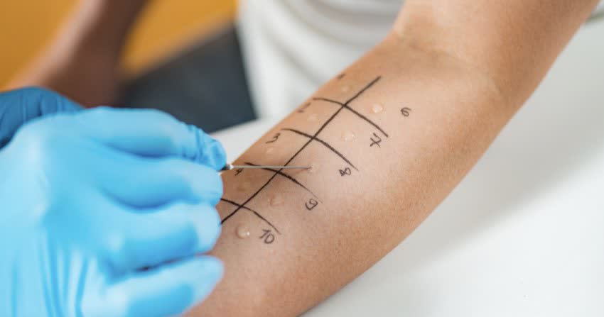 Close up braccio di paziente durante un prick test per allergia