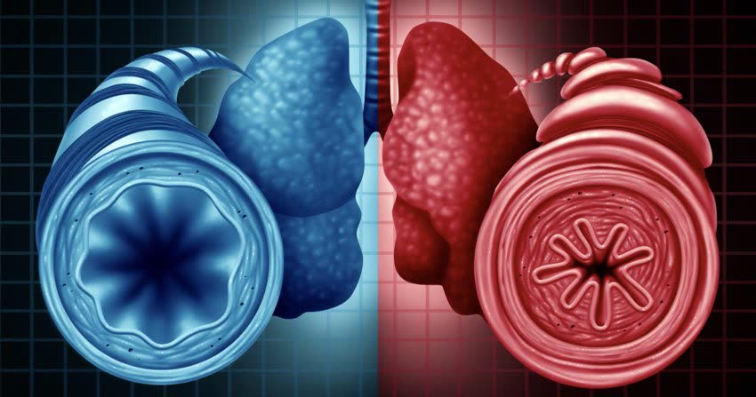 Immagine schematica che mostra bronchi in salute e bronchi ristretti segno tipico di asma
