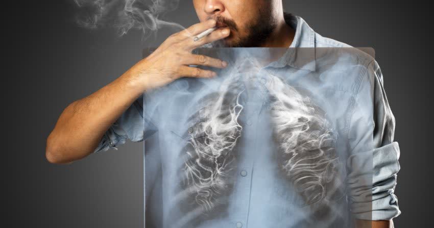 Immagine di un uomo che fuma con sovrapposizione di una lastra di polmoni che si riempie di fumo
