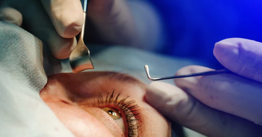Close up occhio durante intervento per cataratta