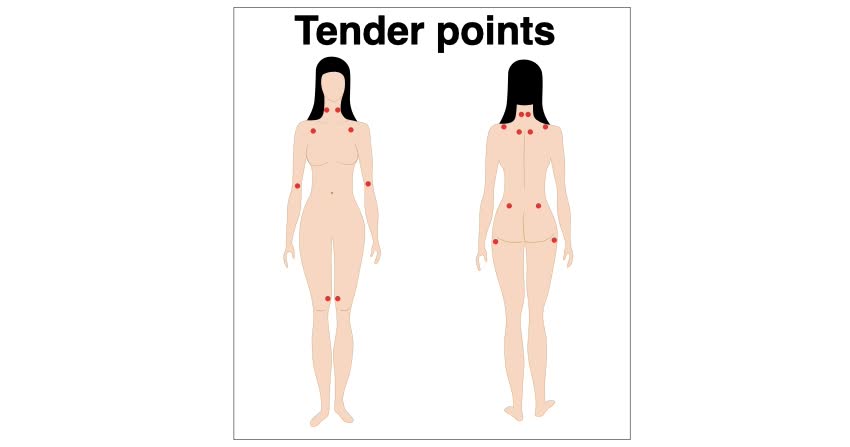 Localizzazione tender point sul corpo umano