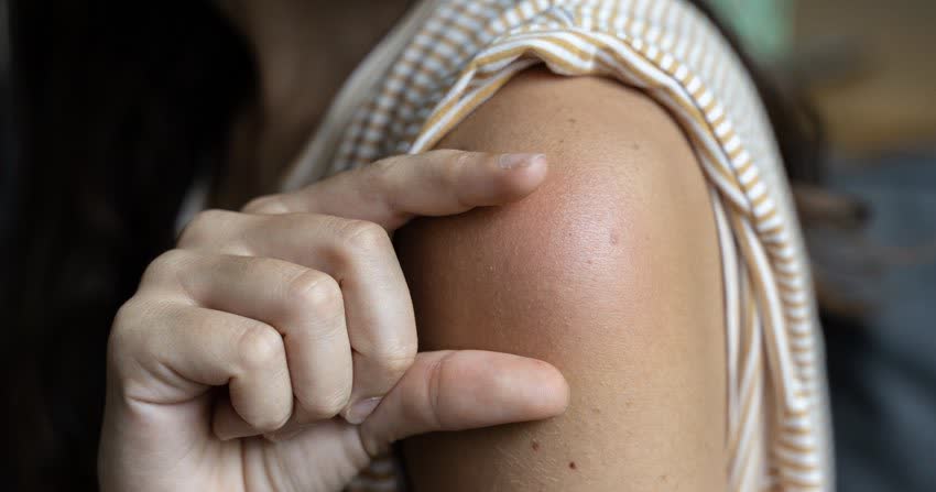 Gonfiore su braccio post vaccino