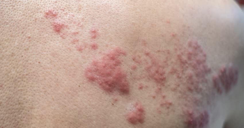 Close up di rash cutaneo da Herpes zoster