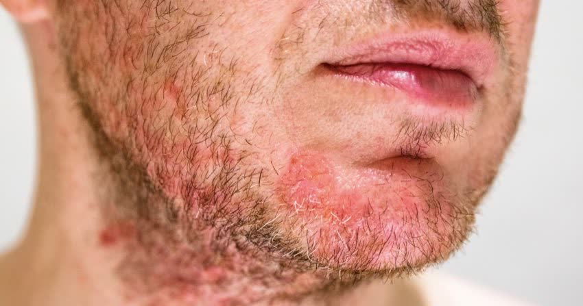 Close up viso di uomo con dermatite seborroica