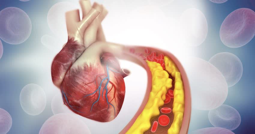 Clipart di un arteria coronaria occlusa che porta sangue al cuore