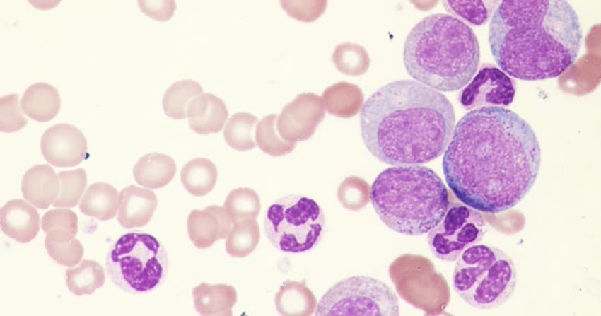 piastrine basse e leucemia