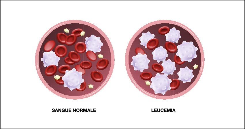 Leucemia linfatica cronica e sangue sano