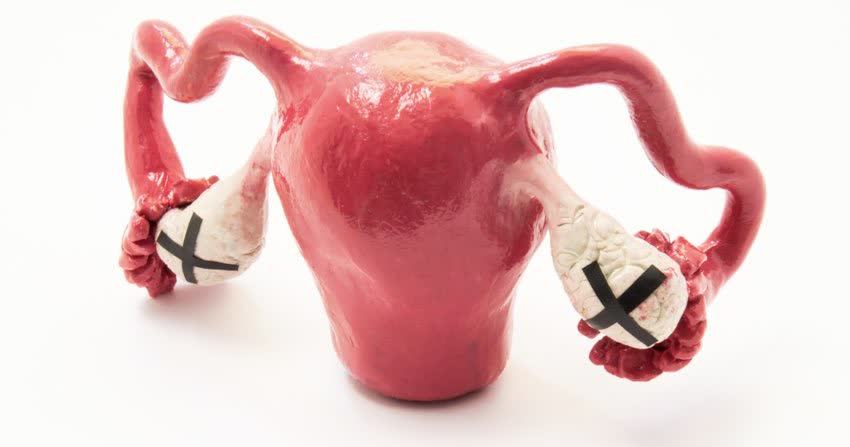 Modellino utero e ovaie con croce su ovaie a indicare inattività come da menopausa