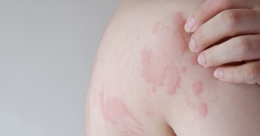 Orticaria da stress sintomi