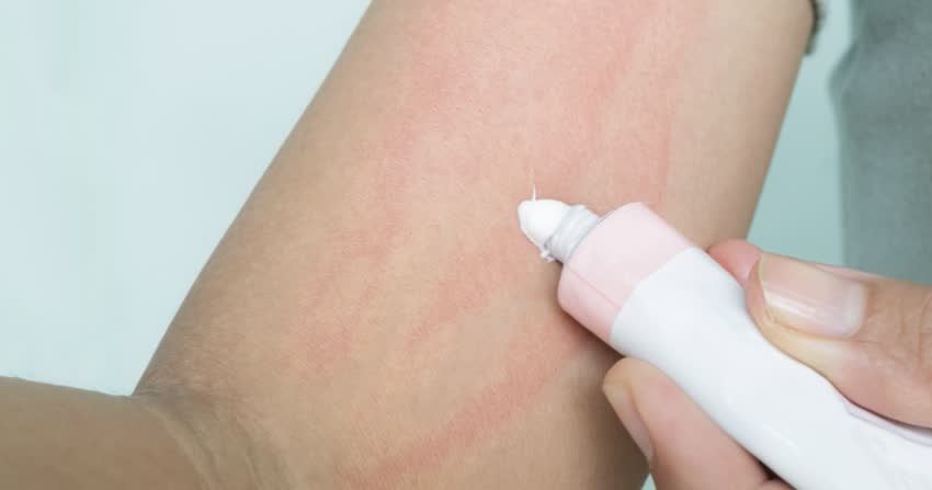 Orticaria da stress rimedi