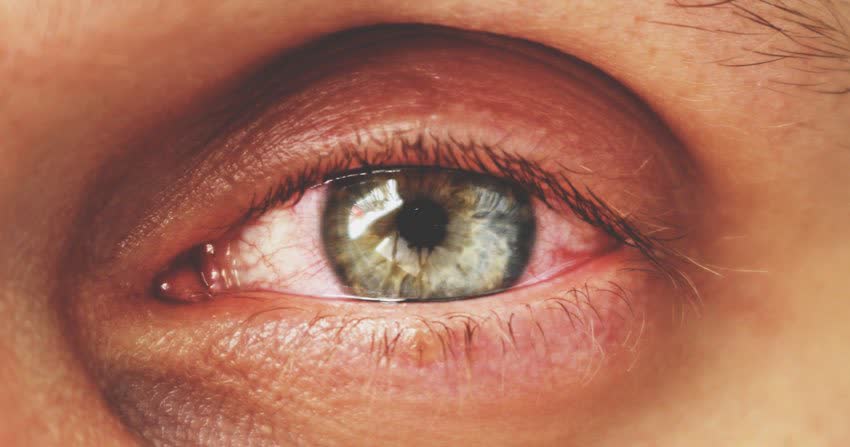 Close up occhio arrossato ed infiammato
