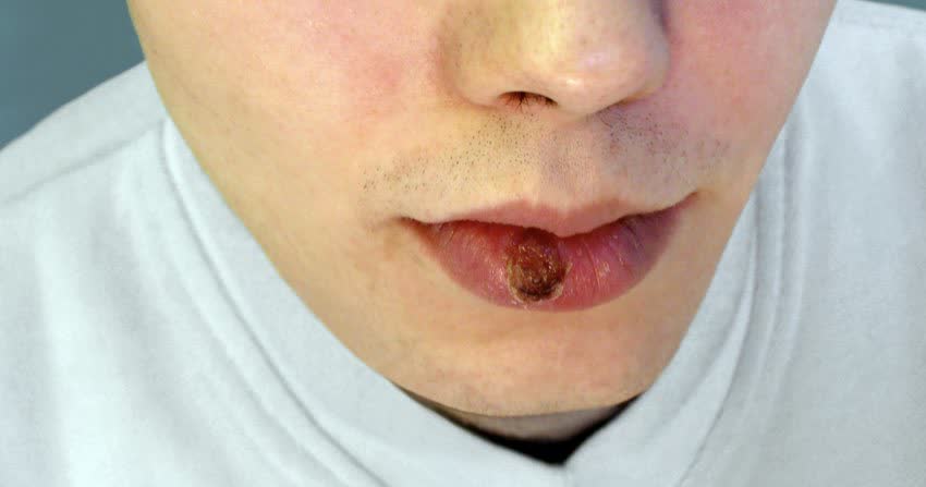 Close up sifilioma labbro inferiore