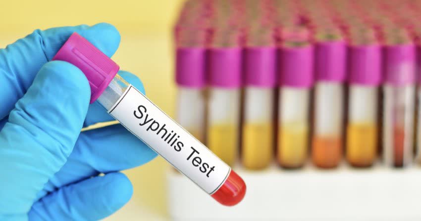 Campioni di sangue su cui testare positività per sifilide sullo sfondo di campione positivo