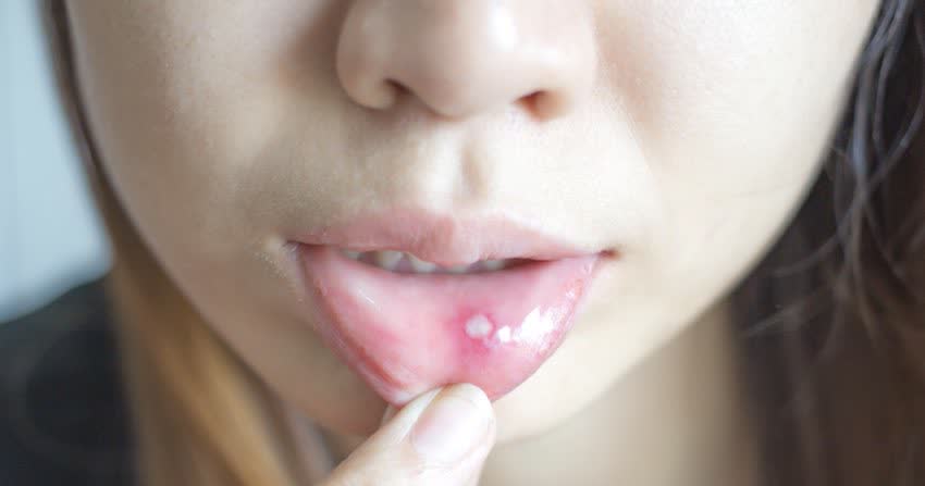 Close up labbro interno di donna con afta da stomatite