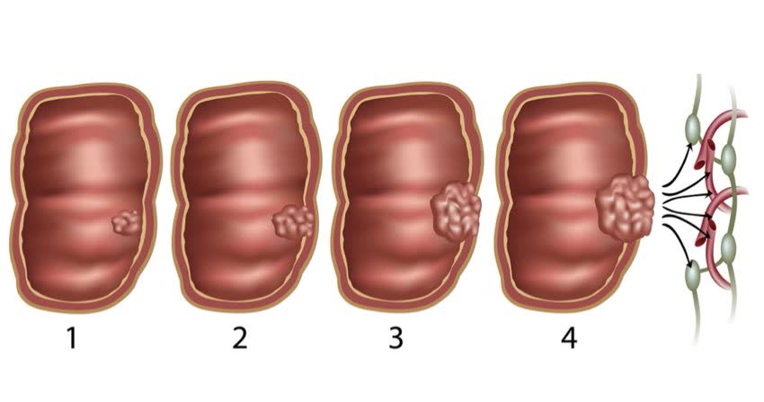 Cartoon rappresentativo degli stadi di tumore al colon