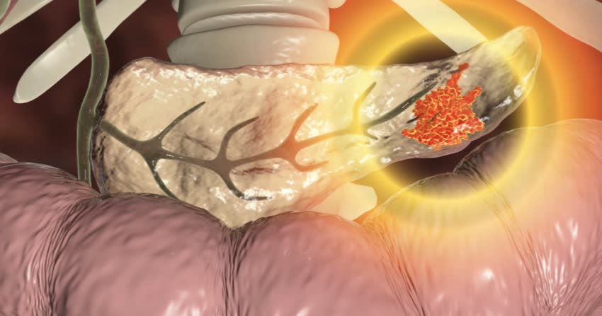 Tumore al pancreas: quali sono le aspettative di vita?