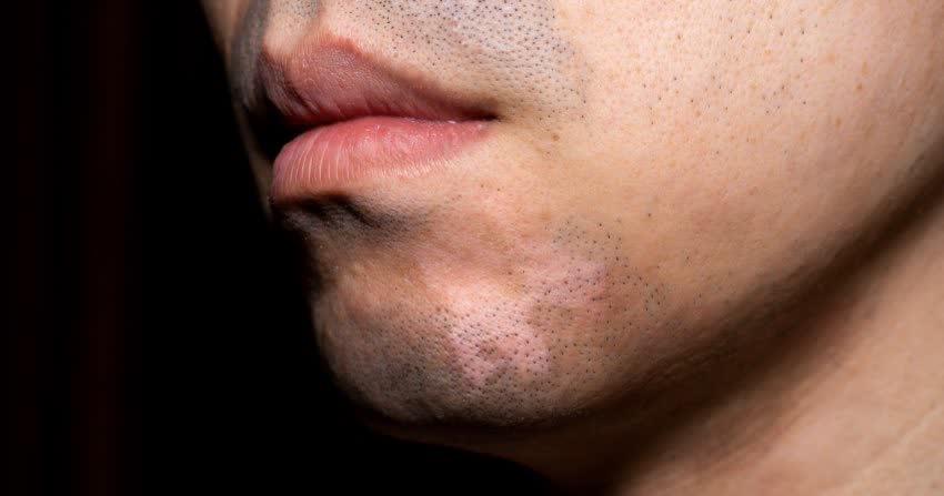 Close up viso di uomo con vitiligine sulla barba