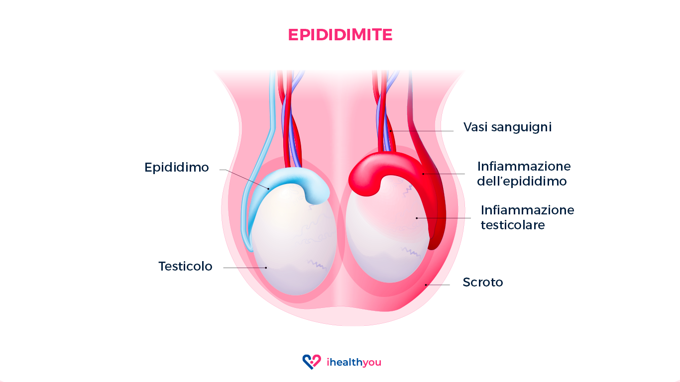 2021_11_15_Epididimite