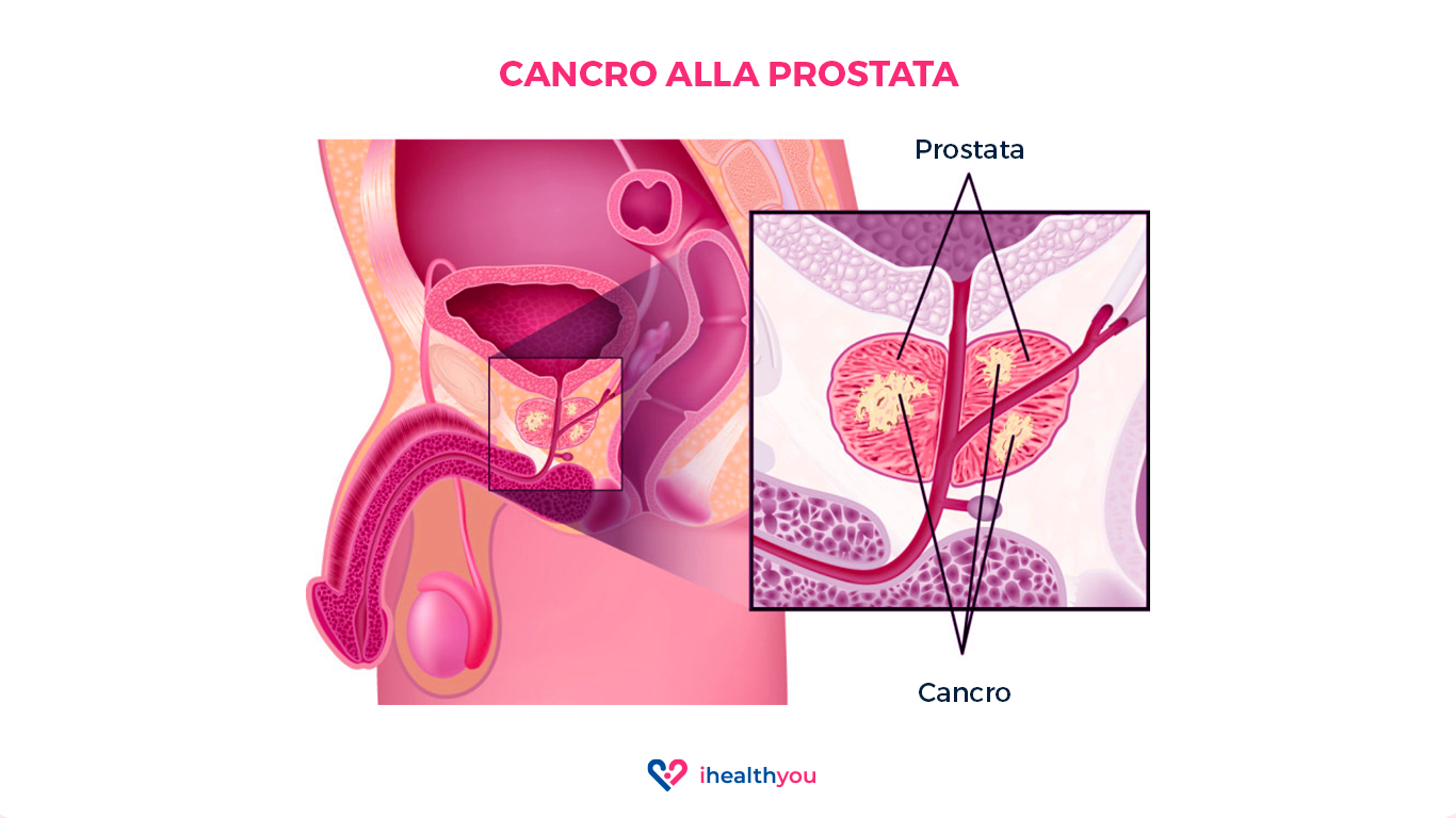2021_11_24_Cancro_Prostata