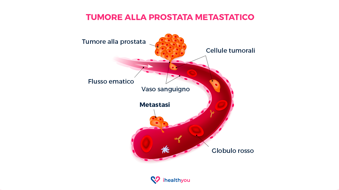 Cos'è Il Tumore Alla Prostata Metastatico?