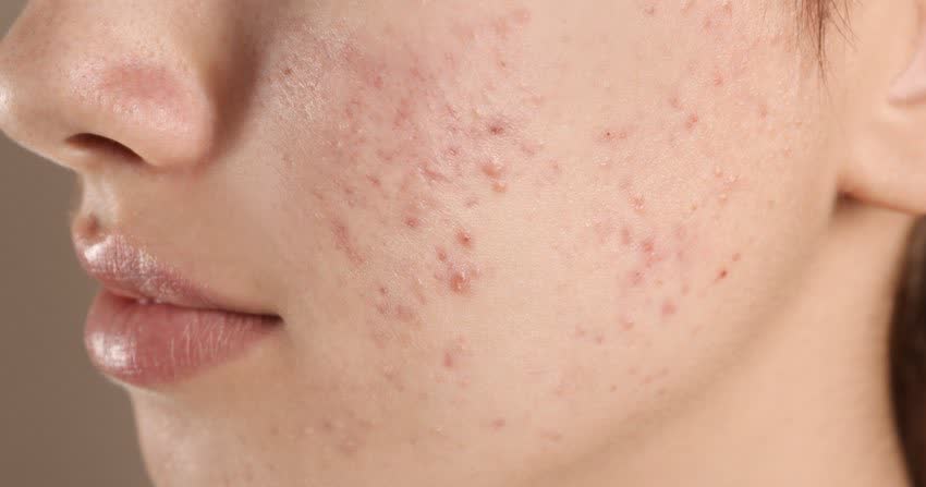 Acne sintomi