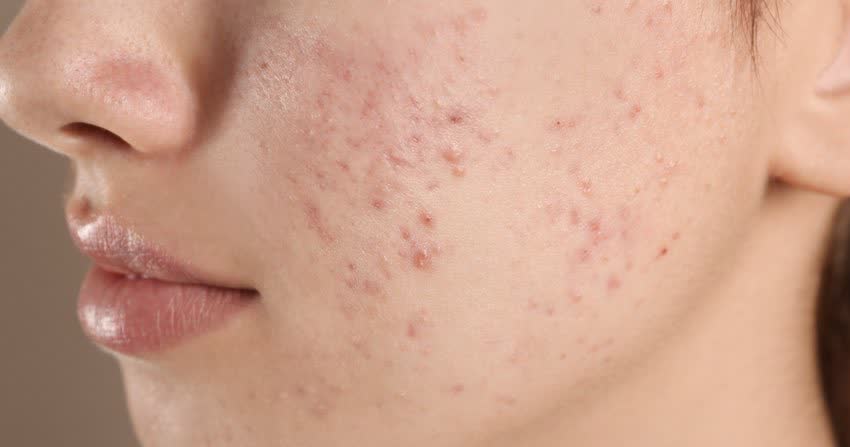Close up viso con acne