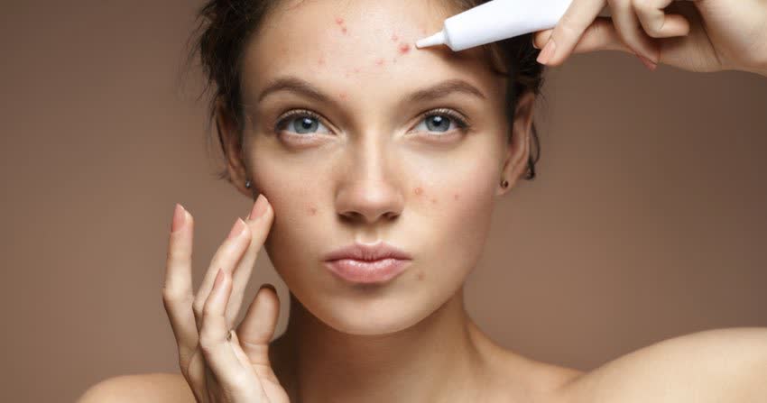 Figura femminile con acne mentre applica crema per il viso