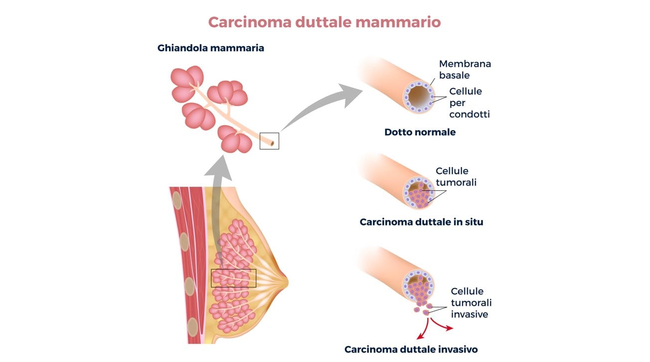 Illustrazione descrittiva delle differenze tra carcinoma duttale mammario normale, in situ o invasivo