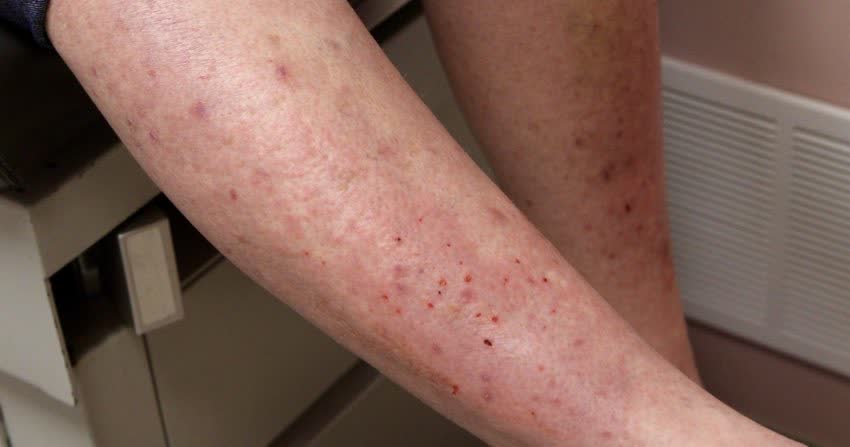 Sfogo di dermatite erpetiforme su gambe di una paziente