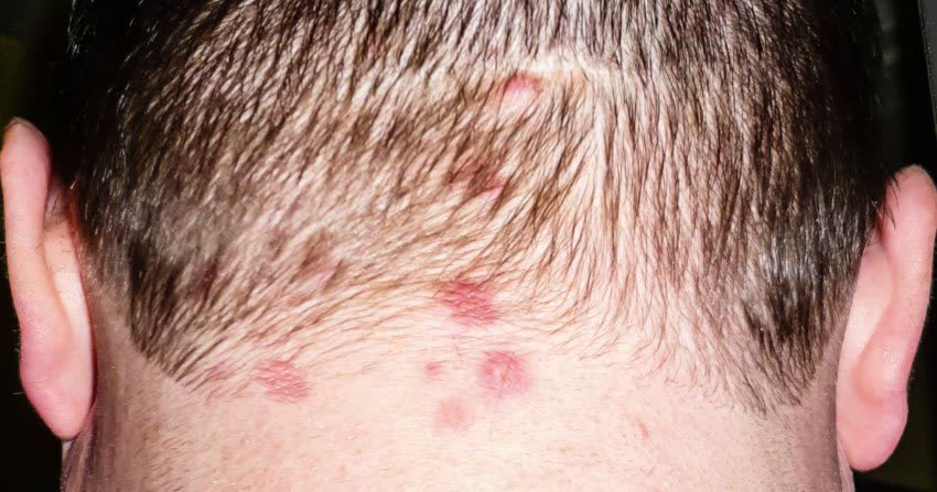 Close up vescicole di dermatite erpetiforme su collo di un paziente affetto da celiachia