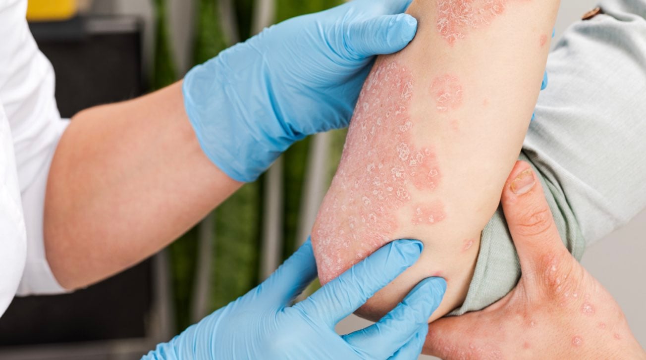 Medico osserva il braccio di un paziente con dermatite atopica