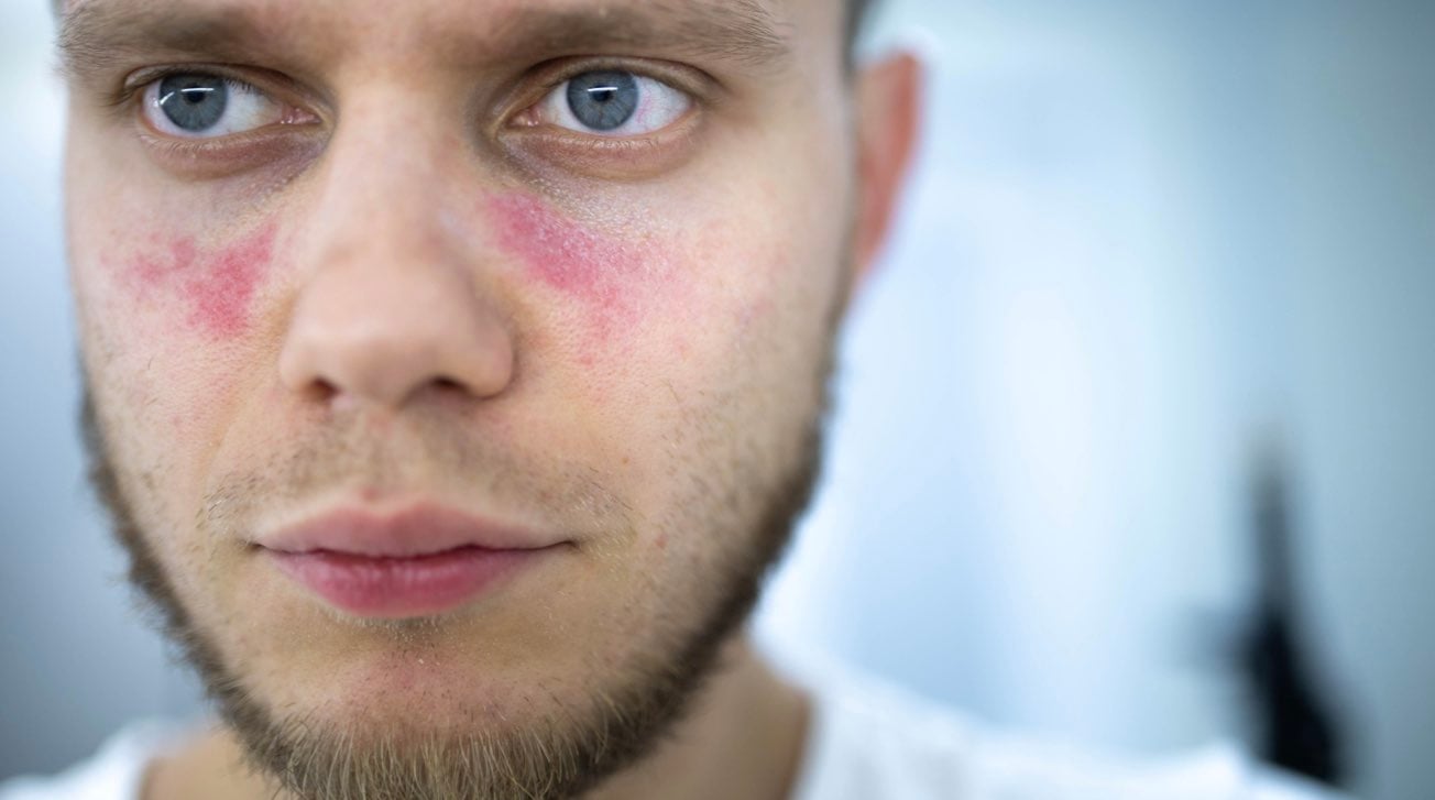 Primo piano del viso di un uomo con rash cutaneo a causa della LES