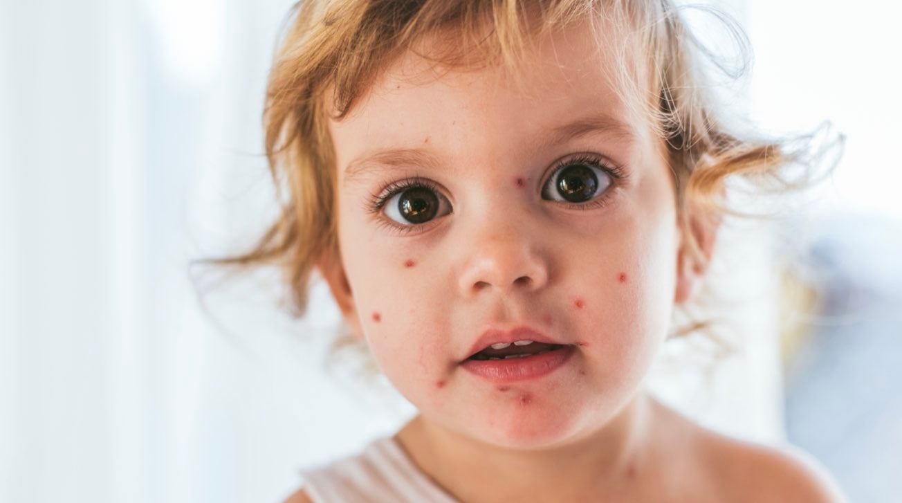 Bambina con macchie cutanee rosse sul viso a causa della varicella