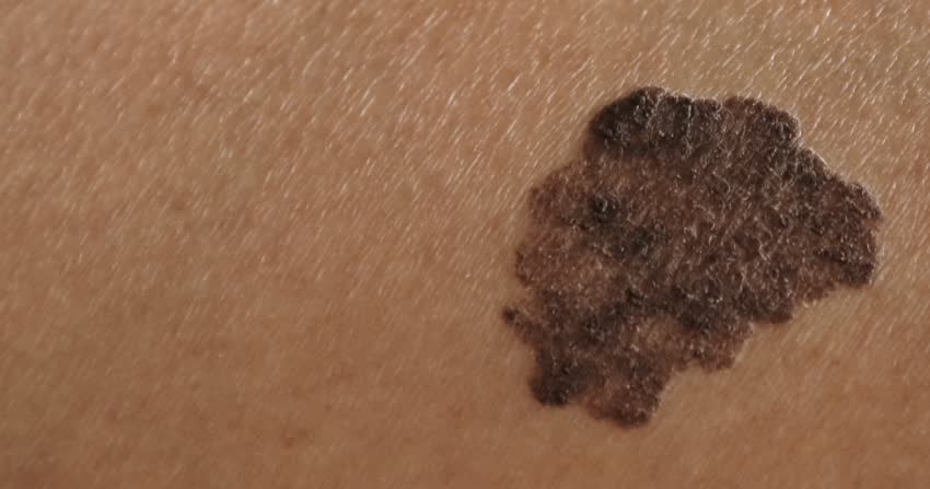 Close up melanoma