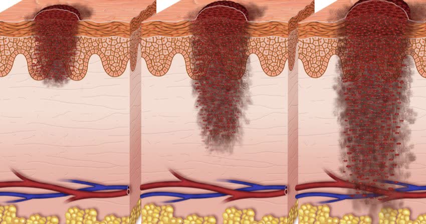 Rappresentazione 2D dello sviluppo di melanoma metastatico in sezione di cute