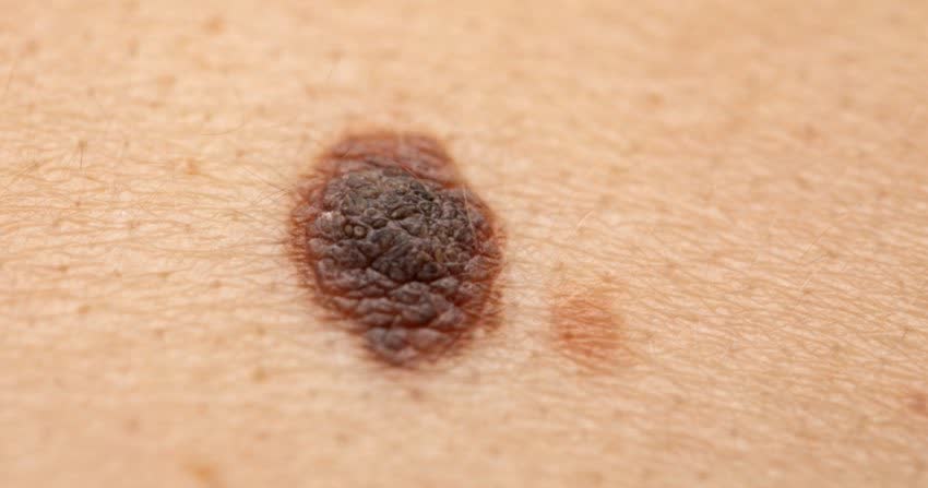 Close up di melanoma avanzato su pelle
