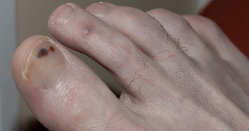 Melanoma unghia e dito del piede