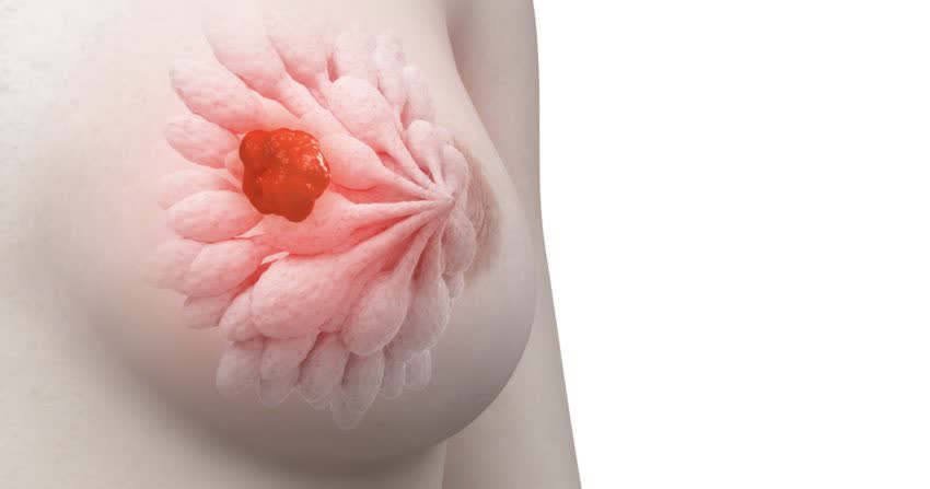 Pittogramma tumore al seno