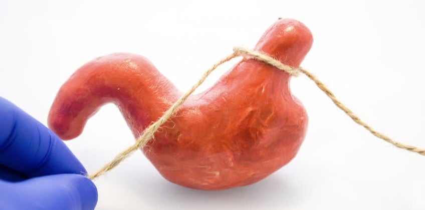 foto di uno stomaco in miniatura con un nodo con spago per rappresentare il bendaggio gastrico