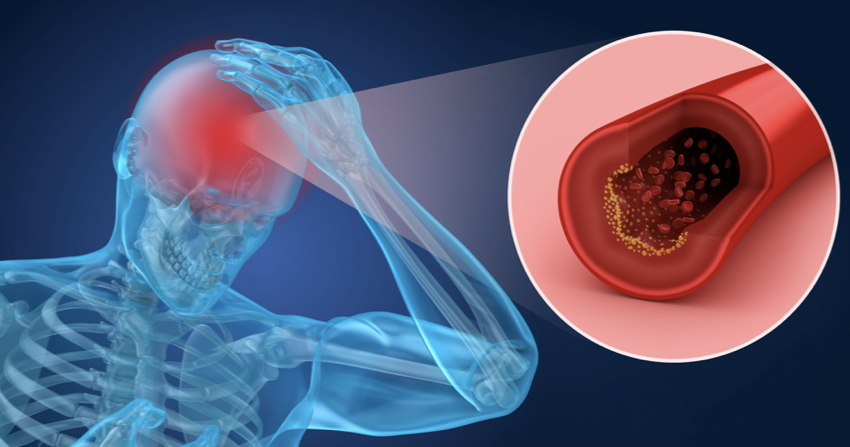 Differenza Tra Ictus E Emorragia Cerebrale Quali sono le differenze tra ictus e ischemia?