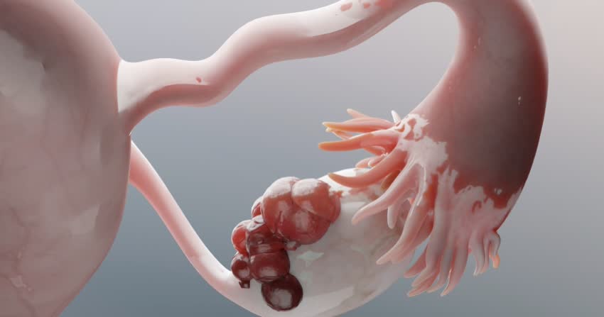 tumore alle ovaie e liquido nella pancia Alla scoperta del carcinoma ovarico: parola all'esperto
